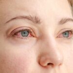 Pink Eye