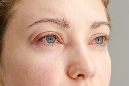Pink Eye