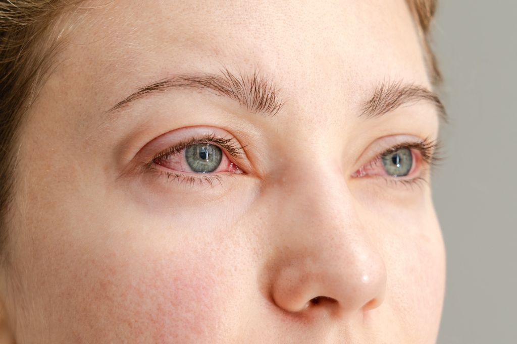 Pink Eye