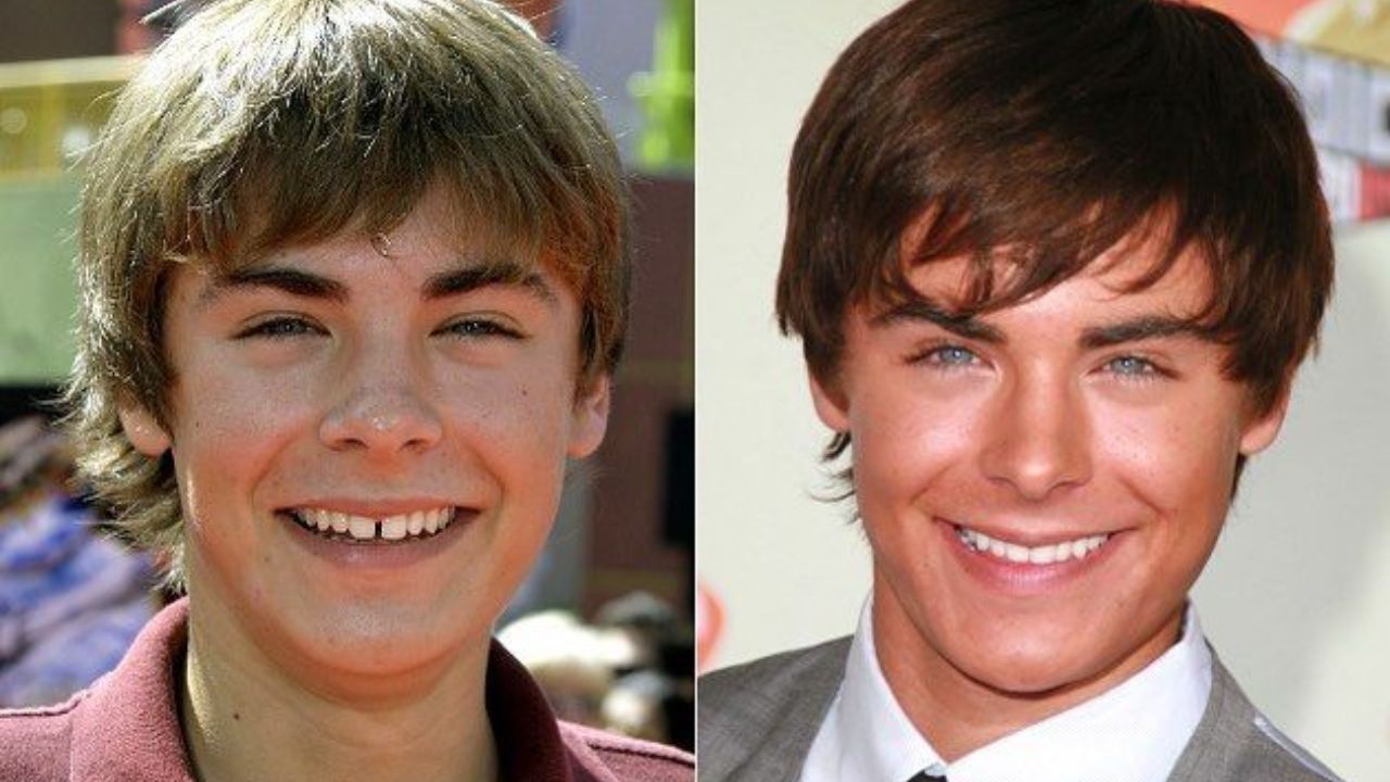 celebrity veneers