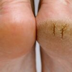glycolic acid for feet