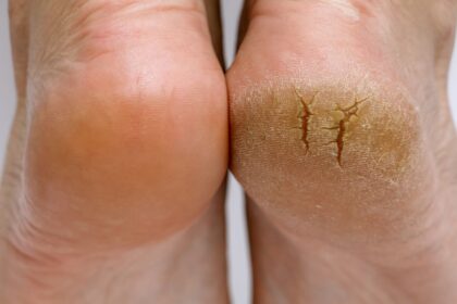 glycolic acid for feet
