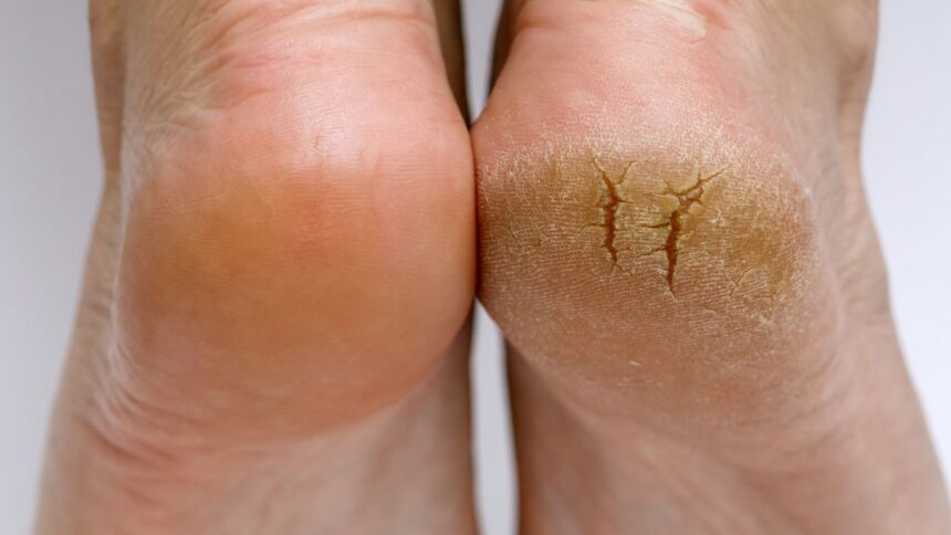 glycolic acid for feet