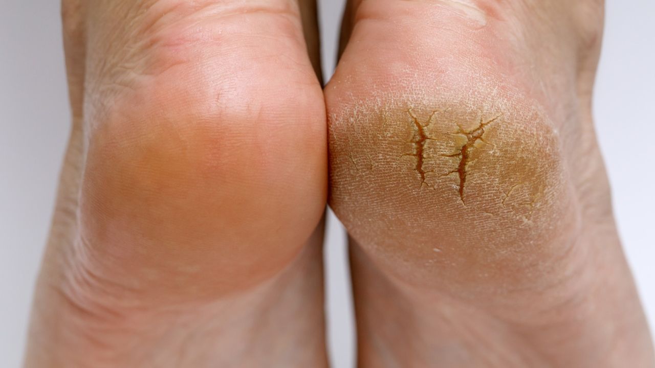 glycolic acid for feet